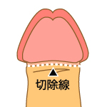 短小（短小包茎）改善法