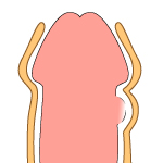 ペニスにしこりがある