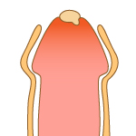 尿道口から膿が出る