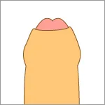 仮性包茎のイメージ