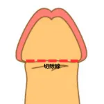 短小包茎改善法による亀頭増大