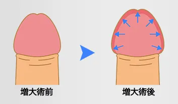 亀頭増大