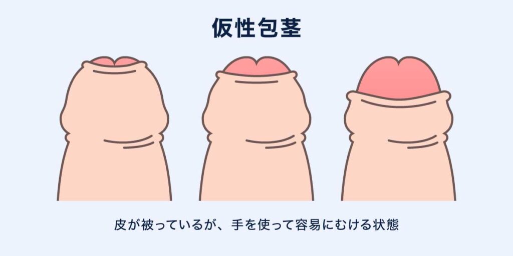 仮性包茎の説明