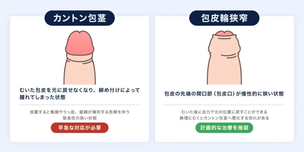 カントン包茎と包皮輪狭窄の説明