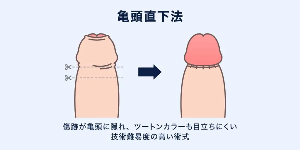 亀頭直下法の説明