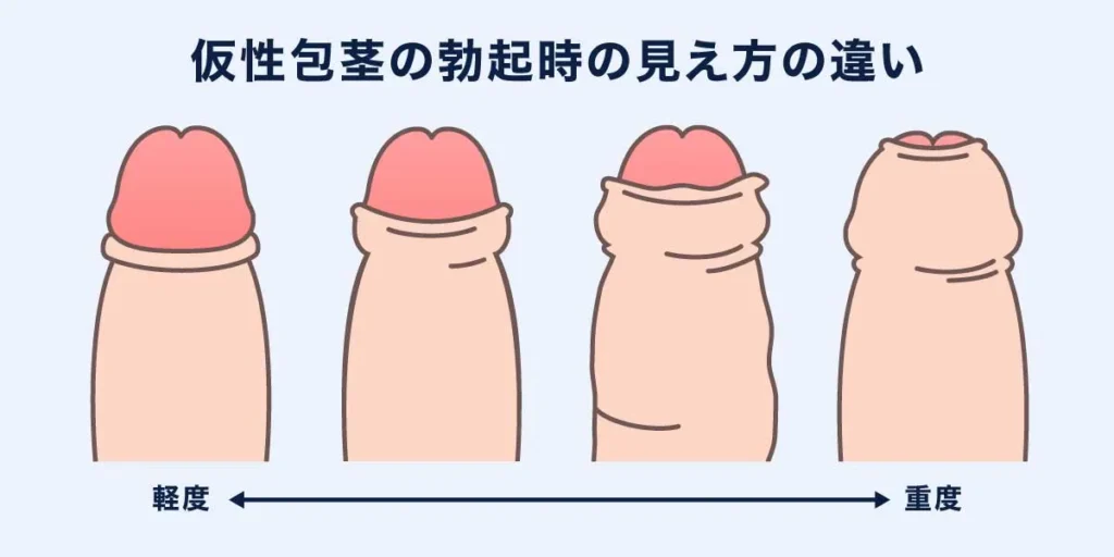 仮性包茎の勃起時の見え方の違いの説明