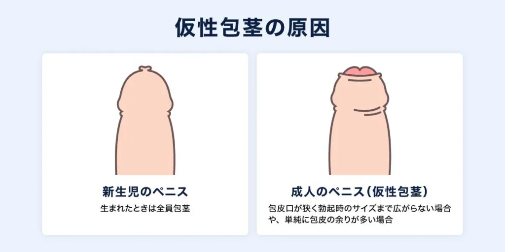 仮性包茎の原因の説明