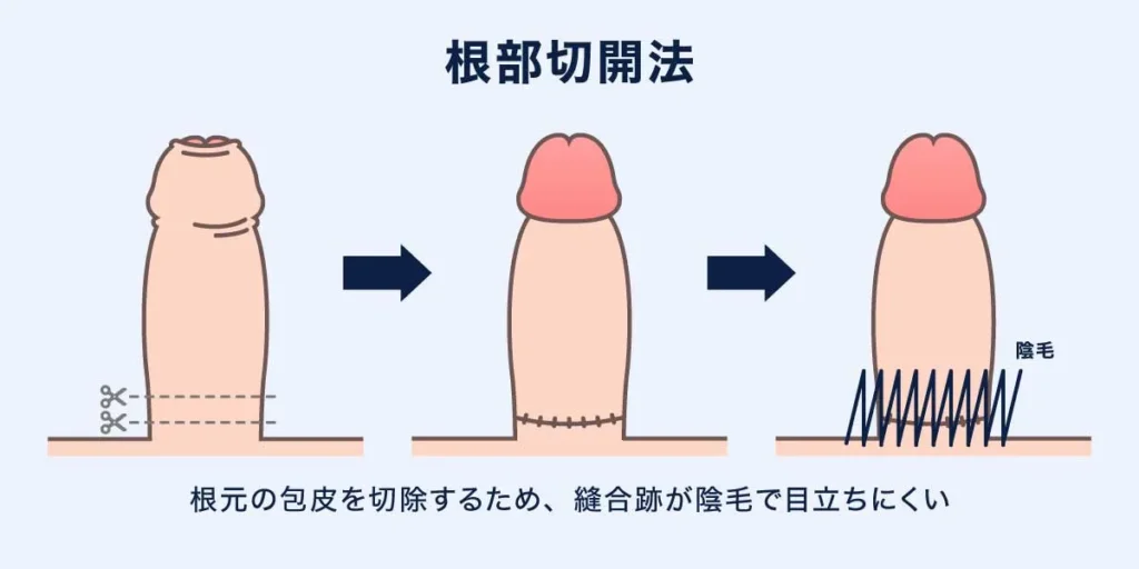 根部切開法の説明