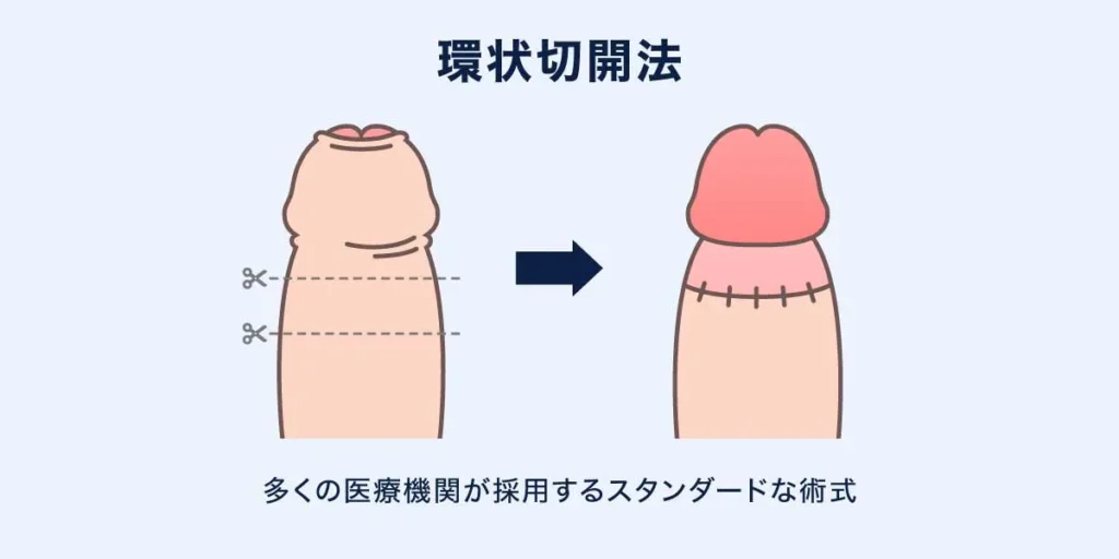 環状切開法の説明